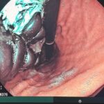 20 mágnest nyelt le egy 10 éves gyerek, a Heim Pál kórházban mentették meg az életét